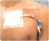 BX/50 CATH STRIP RECLOSABLE  CATHETER FASTENER